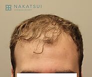 Hair Transplant Calgary | Nakatsui Hair Transplant :