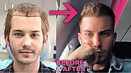 A Beginners Guide to Hair Transplant in Calgary: Cost, FUE, Before/After