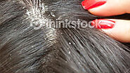 Dandruff / Itchy scalp - The London Dermatologist