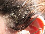 Dandruff Itchy Flaky Scalp Treatments | London | HairologyLondon.com