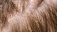 Dry Scalp Treatments London | Dandruff Treatment London | Flaky Itchy Scalp London | Hairology - 'The Root to Healthi...