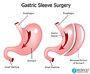 Gastric Sleeve - Tijuana, Mexico - Oasis of Hope Bariatrics - Surgery