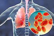 Treatment for Pneumonia - Philadelphia Holistic Clinic - Dr. Tsan & Assoc.