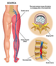 Treatment for Sciatica Pain - Philadelphia Acupuncture Clinic - Dr. Tsan