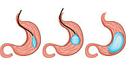 Juárez Bariatric Medical Center - Gastric Bypass | Juárez Bariatric Medical Center