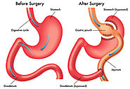Bariatric Surgery | Dignity Health Central Coast
