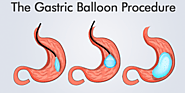 Gastric banding - weight loss procedure in Reynosa