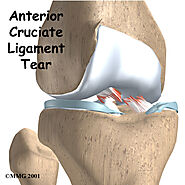 Physiotherapy in Calgary for Anterior Cruciate Ligament Injury