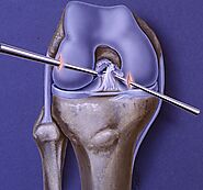 ACL surgery? - Calgarypuck Forums - The Unofficial Calgary Flames Fan Community