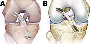 ACL and PCL | Knee Repair or Reconstructive Surgery | Free consultation