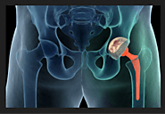 Private Hip Replacement Surgery in Calgary, Alberta, Canada