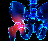 Private Hip Replacement Surgery in Alberta and Toronto, Canada | Clearpoint Health