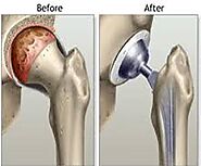 Hip Replacement in calgary