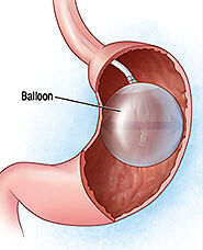 Gastric Balloon for Weight Loss | Barnes-Jewish West County Hospital