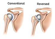 Is reverse arthroplasty or ball in socket joint surgery better?