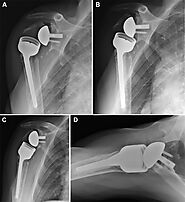 Clinical outcomes and complications of reverse shoulder arthroplasty used for failed prior shoulder surgery