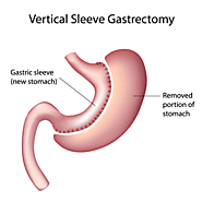 Gastric Sleeve in India at low cost | IndiCure