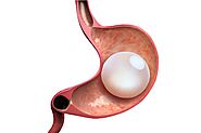 Bariatric weight loss nonsurgical - gastric balloon information and locations in Mexico