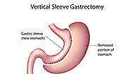 Website at https://www.medicoexperts.com/gastric-sleeve/
