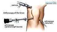Knee Replacement & Arthroscopic Knee Surgery | Timely Medical