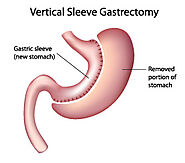 Gastric Sleeve Surgery | UI Health