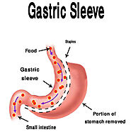 Website at https://www.bariatric-surgery-source.com/gastric-bypass-surgery-in-new-brunswick-canada.html