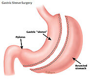 Benefits of Gastric Sleeve Surgery in El Paso | Pro MD Blog