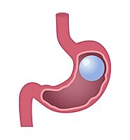 Intragastric Balloon - BMI of Texas