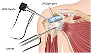 Shoulder Surgery | Rotator Cuff Surgery
