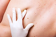 The Benefits of Mohs Surgery for Saving Skin Health