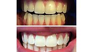 Cosmetic Teeth Whitening: A Step Toward Oral Rejuvenation