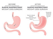 Sleeve Gastrectomy Weight Loss Surgery, Gastric Sleeve Surgery - Suwanee, Johns Creek, Alpharetta | Atlanta Bariatrics
