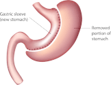 Website at https://www.obesitycoverage.com/gastric-sleeve-reference-manual/