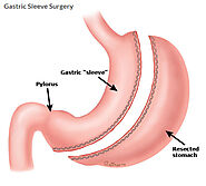 Sleeve Gastrectomy Surgery at Mercy Weight Management Center in Toledo, Ohio