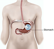 Gastric Balloon Surgery Dallas | Non-Surgical Weight Loss Balloon System