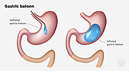Gastric Balloon Poland - Find the best Intragastric Balloon Surgery clinics in Poland