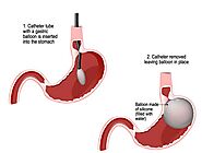 Gastric Balloons | Columbia University Department of Surgery