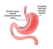 Gastric Sleeve surgery (Sleeve Gastrectomy) | Barrington, IL