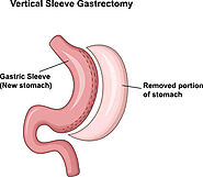 Gastric Sleeve Surgery in Tijuana, Mexico | Gastric Sleeve Services