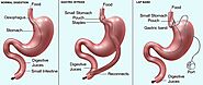 Lap Band Surgery Cost and Procedure Information