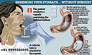 Website at https://cliniquemichelgagner.com/services/surgeries/weight-loss-procedures/gastric-balloonhttps://www.mayo...