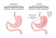 Website at http://thebariatricbuzz.com/types-of-bariatric-surgery/