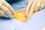 Coronary Angioplasty | Cardiac Treatment | London