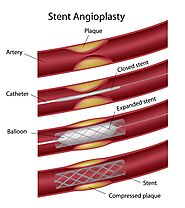Coronary angioplasty London