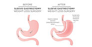 Gastric Sleeve Surgery Ahmedabad | Bariatric Gastric Sleeve