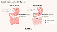 Sleeve Gastrectomy in India | Gastric Sleeve Surgery Cost in India