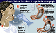 Website at https://lapeerhealth.com/department-of-bariatric-surgery/gastric-balloon/