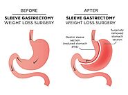 Bariatric Surgery BC | Gastric Bypass Surgery | Clinic Michel Gagner / Clinique Michel Gagner