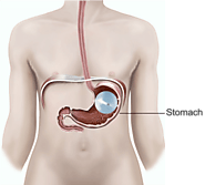 Intragastric Balloon Rupture