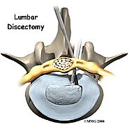 Lumbar Discectomy in Calgary
